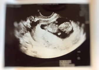 Ultrasound of fetus